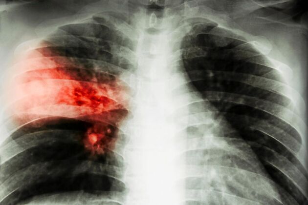  Lunginflammation kan vara partiell, ensidig och dubbelsidig. De små luftblåsorna, alveolerna är slemfyllda och inflammerade.